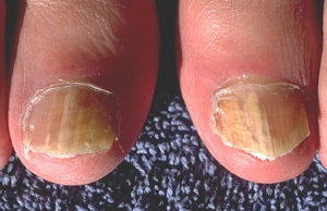 Nagelpilz muss richtig behandelt werden